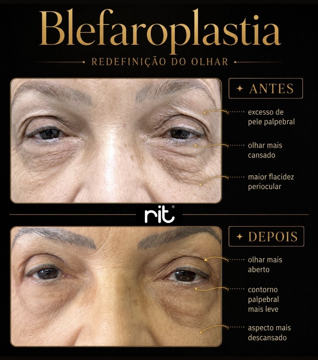 Caso Clínico Blefaroplastia