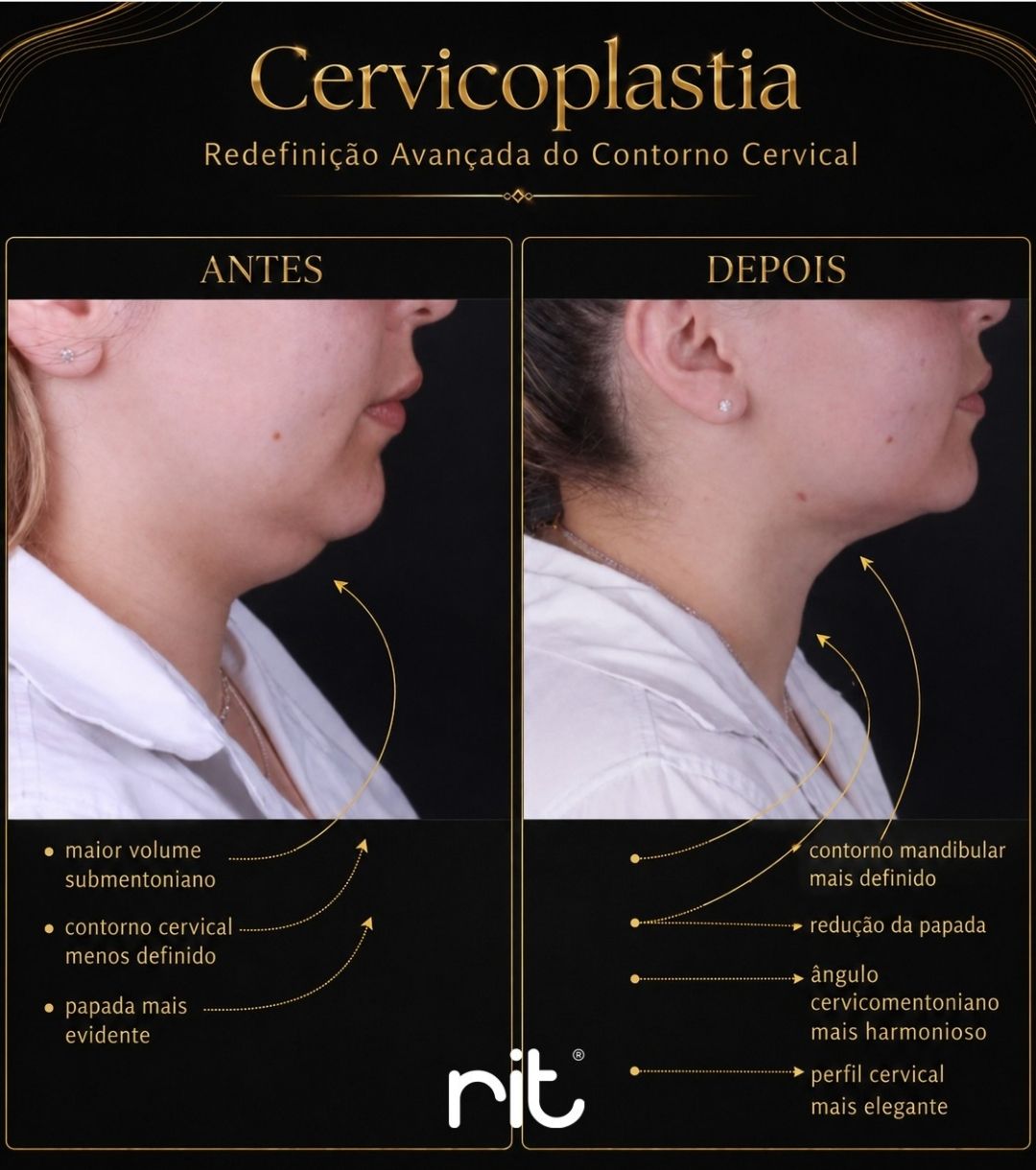 Caso Clínico Cervicoplastia