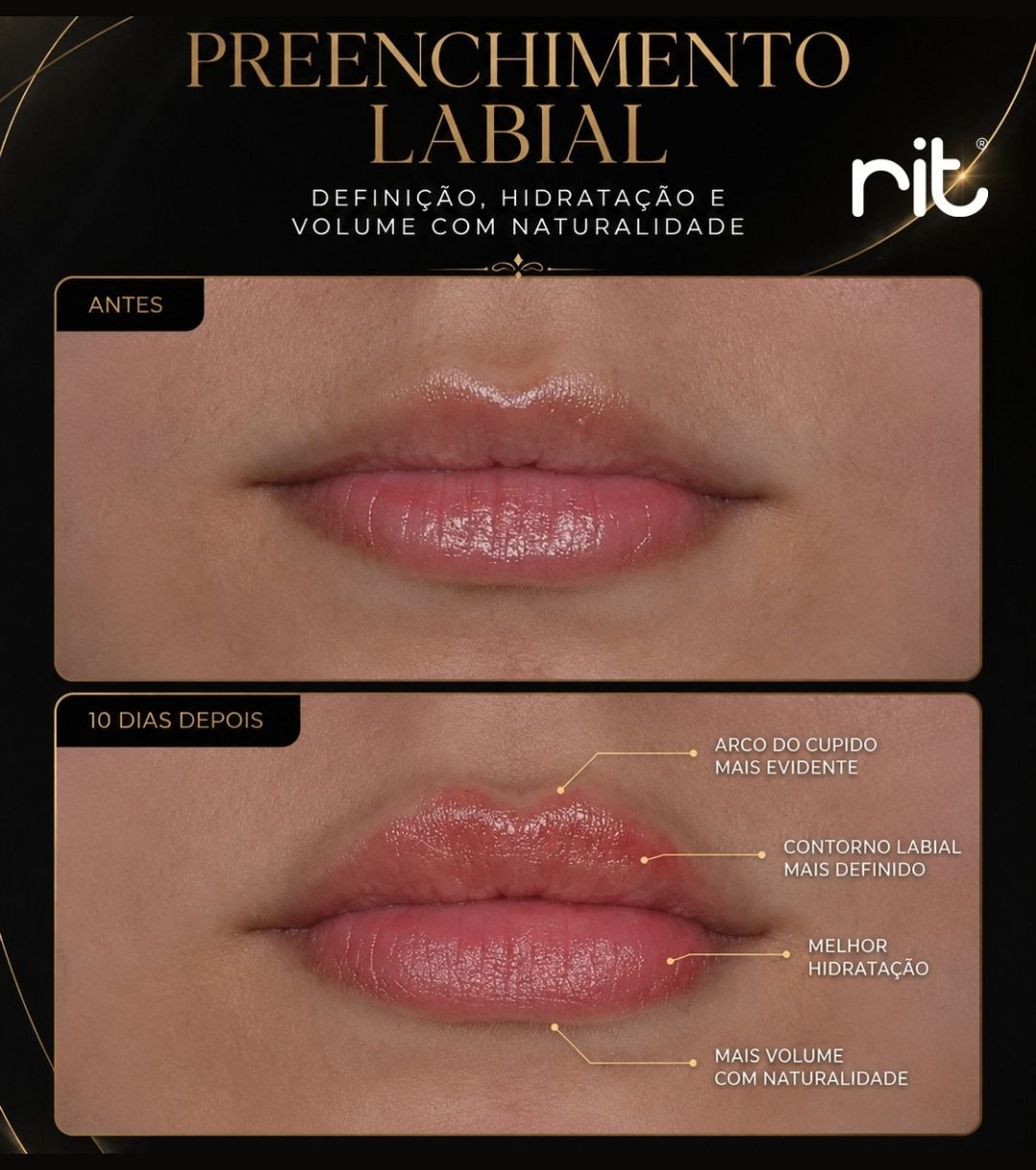 Caso Clínico Preenchimento Labial