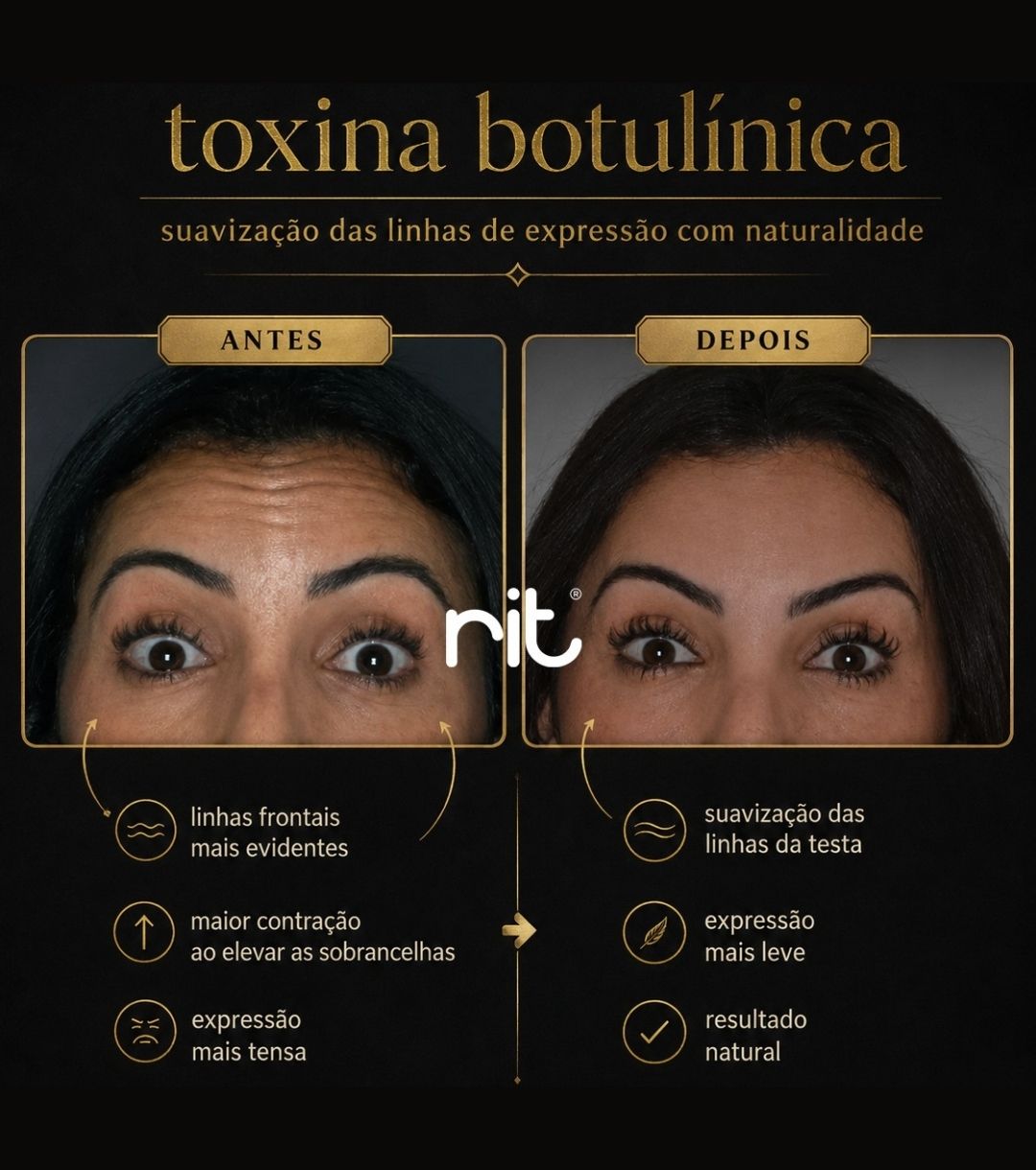 Caso Clínico toxina botulínica