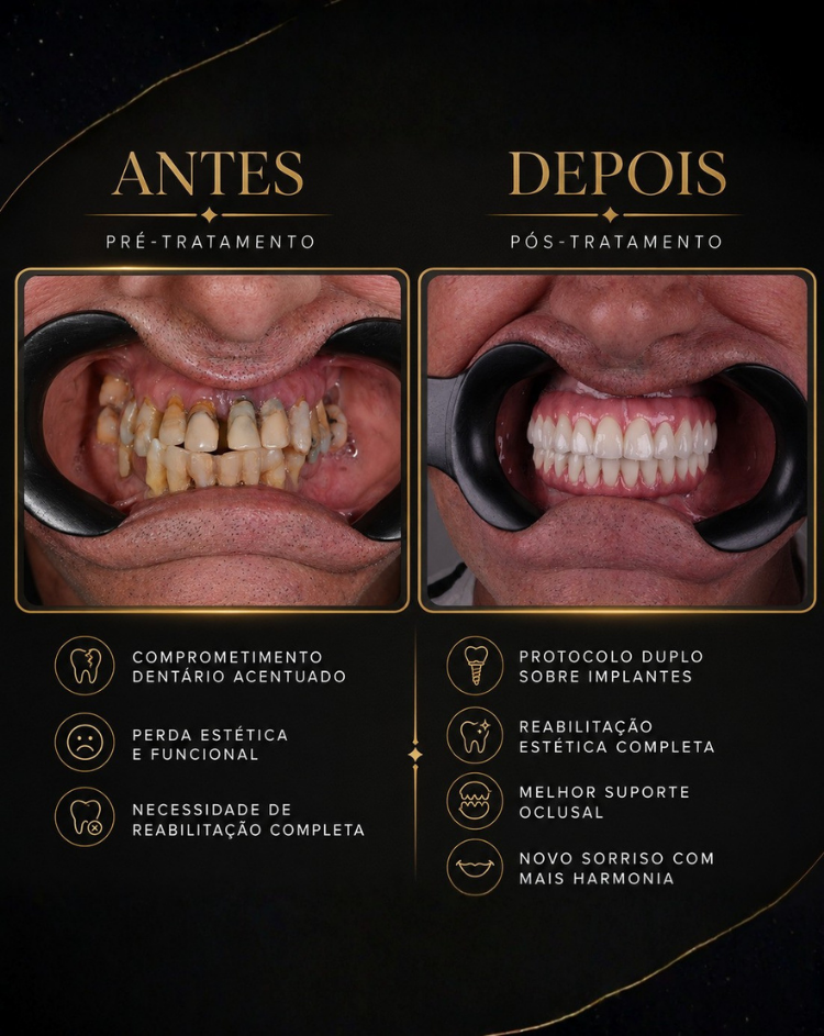 Casos Clínicos de Implantes RiT Odontologia 01