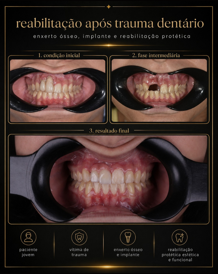 Casos Clínicos de Implantes RiT Odontologia 02