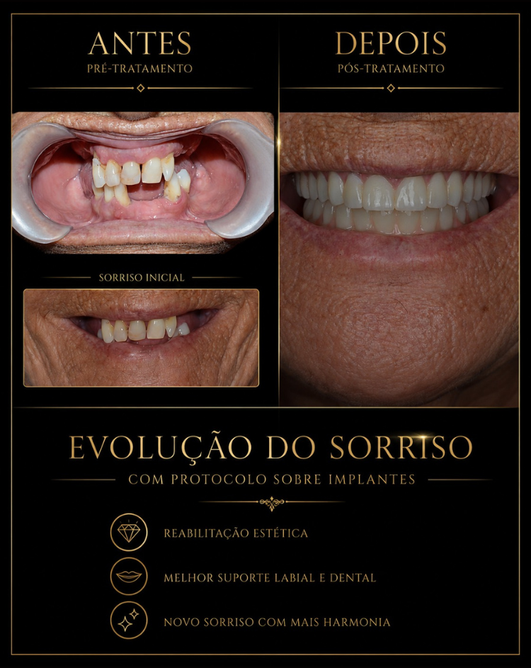 Casos Clínicos de Implantes RiT Odontologia 03