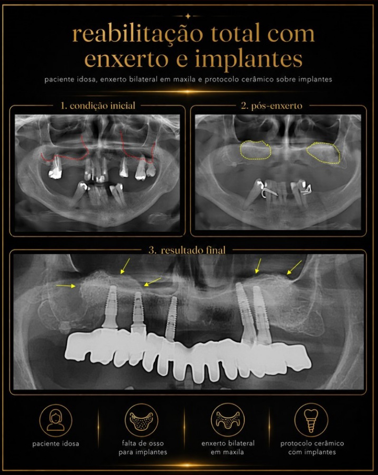 Casos Clínicos de Implantes RiT Odontologia 04