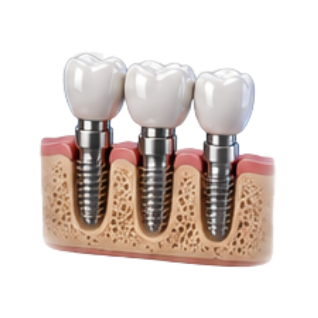 Multiplos Implantes RiT Odontologia