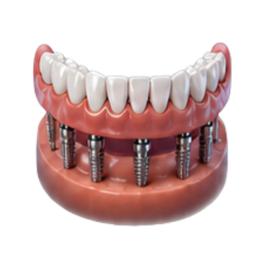 Protocolo sobre Implantes RiT Odontologia